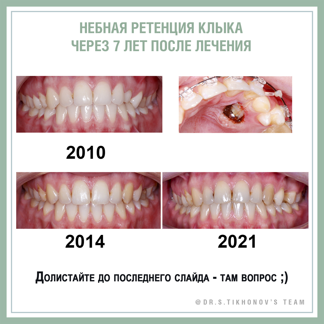 Небная ретенция клыка через 7 лет после лечения. - интересно об ортодонтии,  имплантации и протезировании зубов